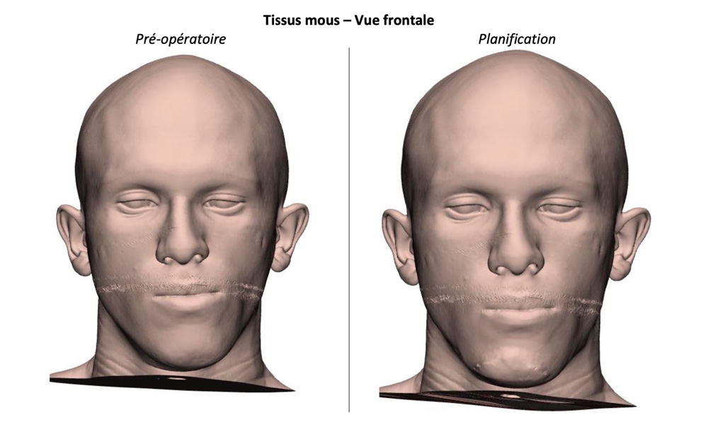 Vue frontale
